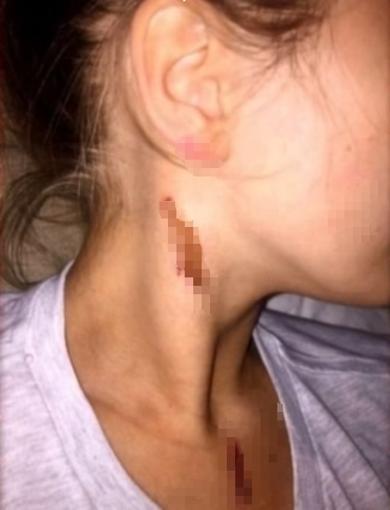 英国泼酸袭击 Acid Attacks How Scared Should We Be的海报